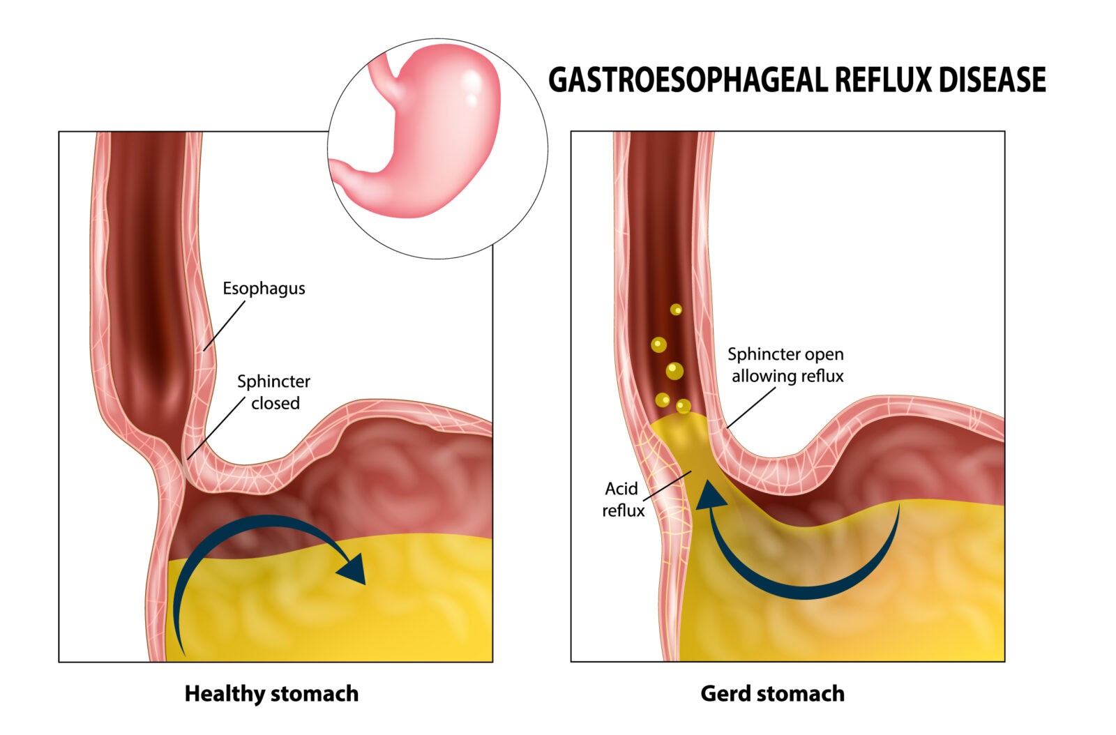 Acid Reflux Surgery In Nagpur
