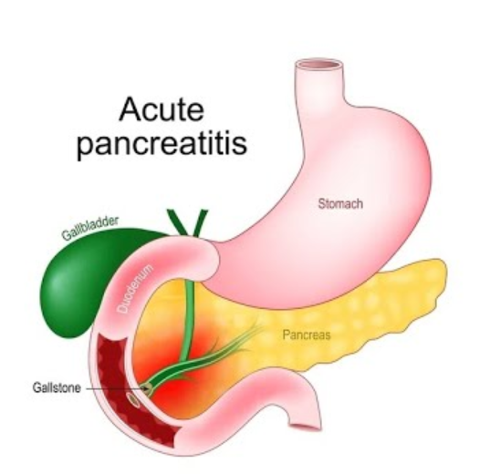Acute Pancreatitis Treatment In Nagpur