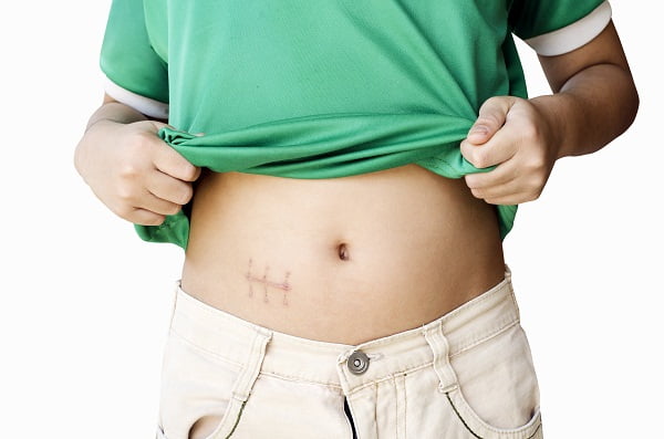 Appendix Surgery In Nagpur