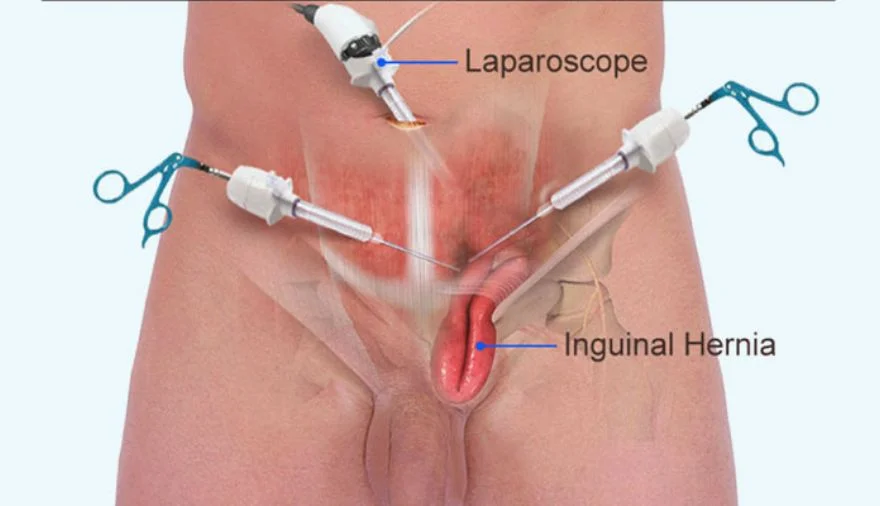 Best Hernia Surgeon In Nagpur