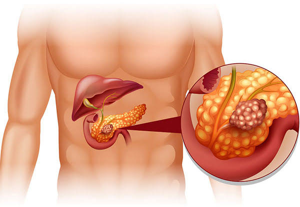 Chronic Pancreatitis Treatment In Nagpur