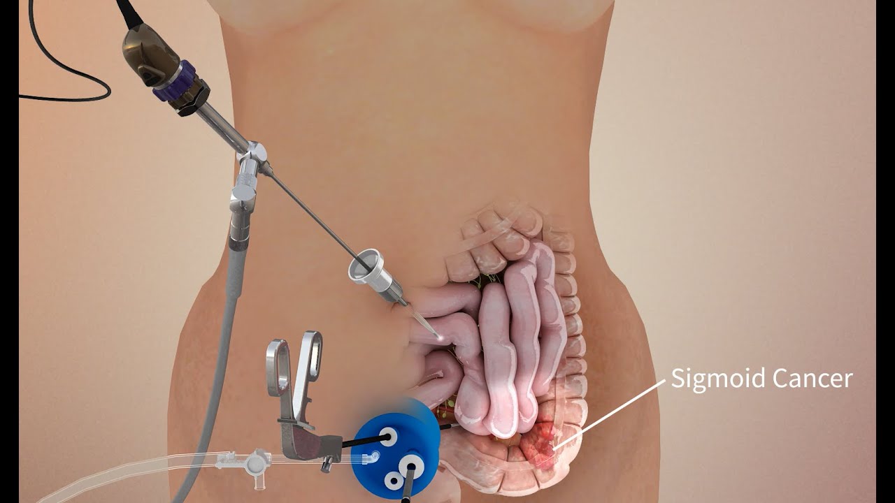 Colon Cancer Surgery In Nagpur