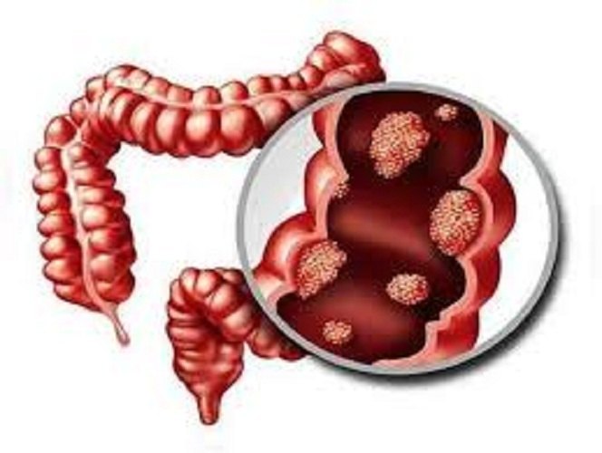 Colonic Malignancy Surgery In Nagpur