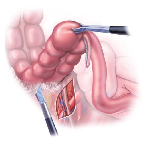 Colonic Surgery In Nagpur