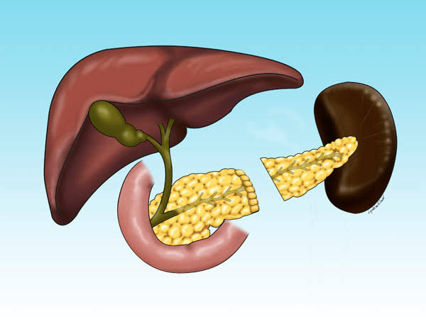 Distal Pancreatectomy Nagpur