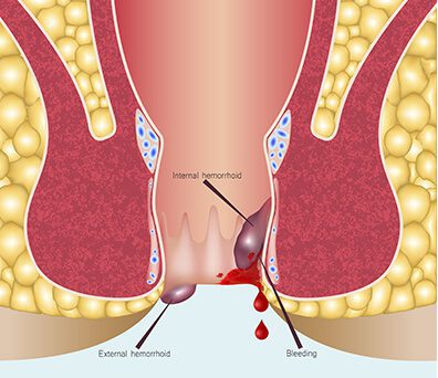 Fissure Treatment In Nagpur