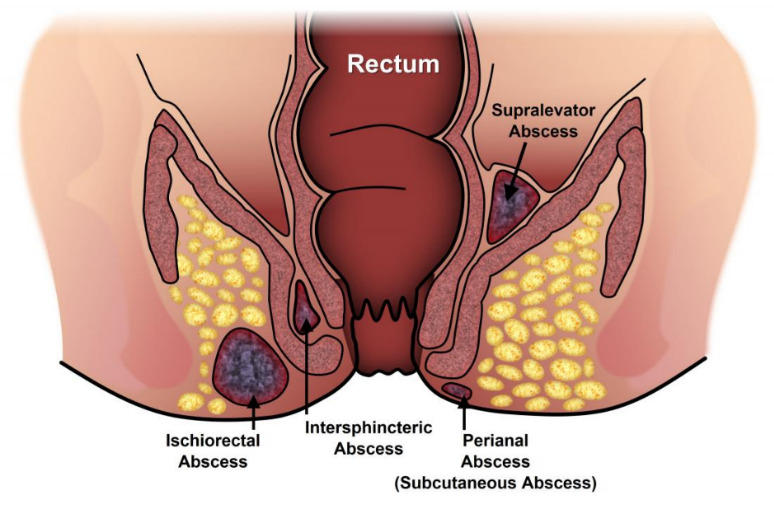 Fistula Treatment In Nagpur