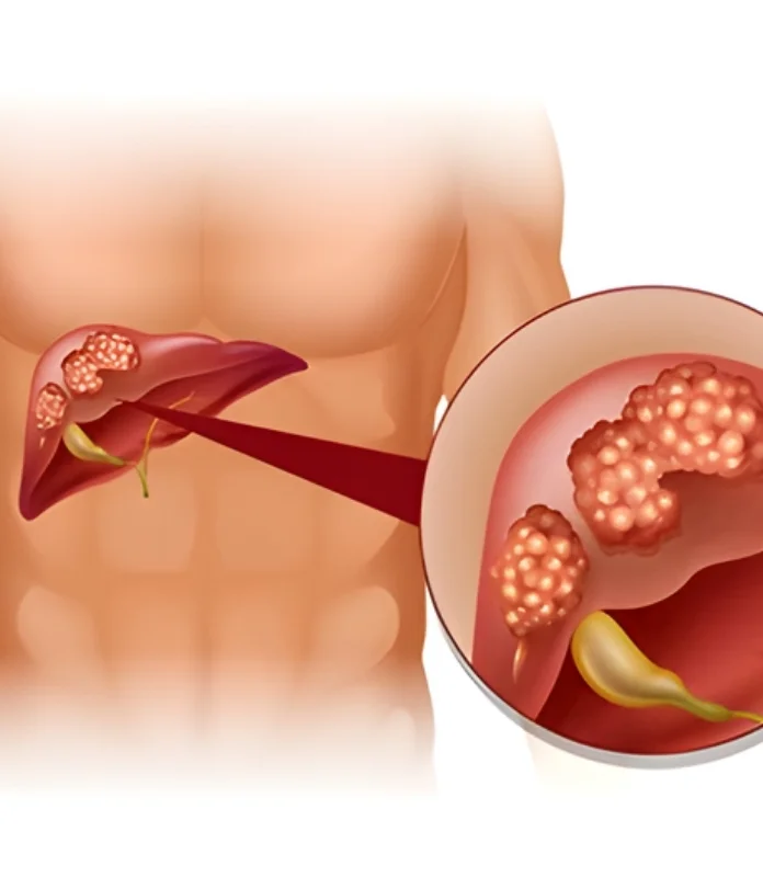 HPB Surgery In Nagpur (Hepato-Pancreato-Biliary Surgery)