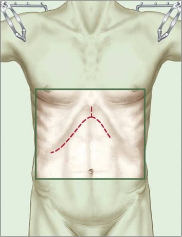 Hepatectomy Surgery In Nagpur