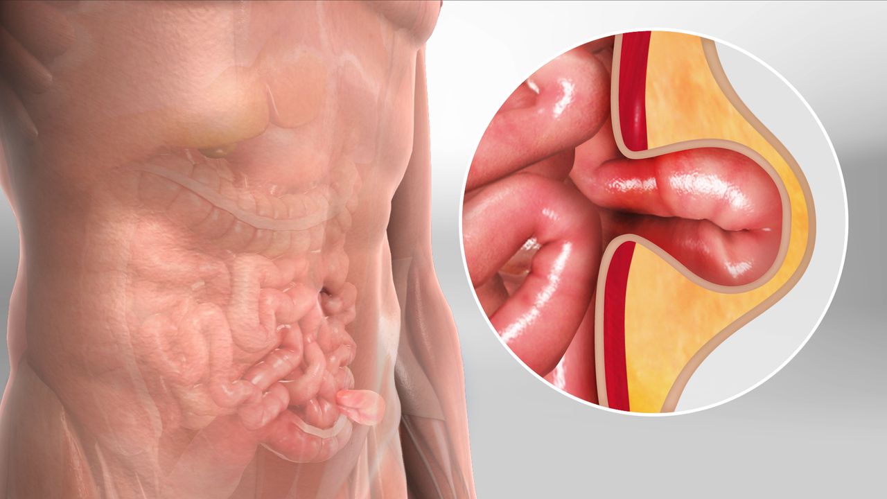 Hernia Surgery In Nagpur