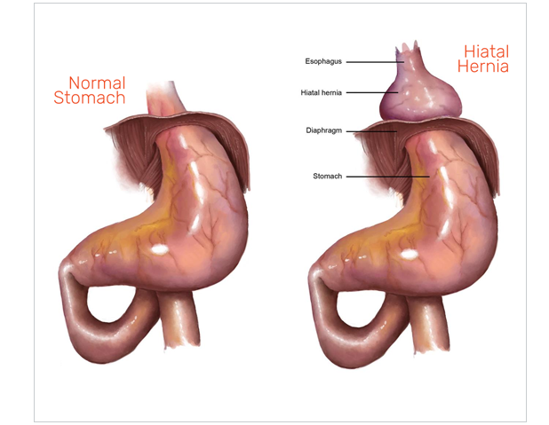 Hiatal Hernia Surgery In Nagpur
