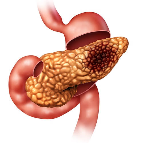 Pancreatic Cancer Surgery In Nagpur