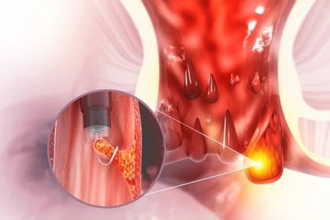 Piles Surgery In Nagpur