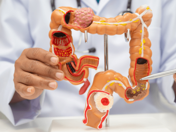 Colon surgery
