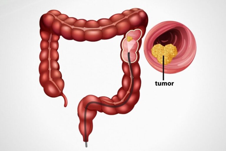 Colonoscopy doctor in chandrapur