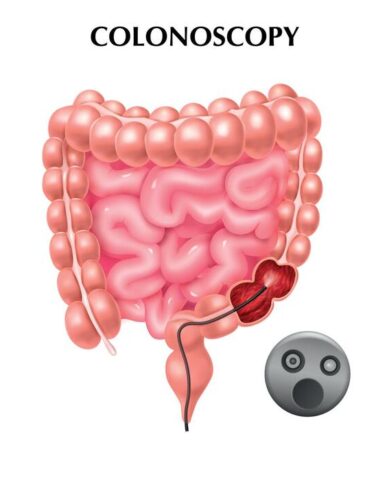 Colonoscopy doctor in shahdol