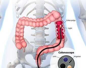 Colonoscopy doctor in yavatmal