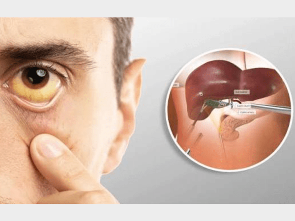 Jaundice Treatment