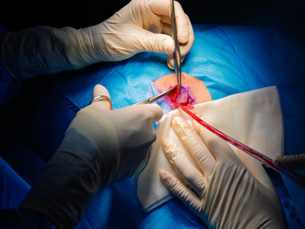 cancer surgery Dr. yogesh bang