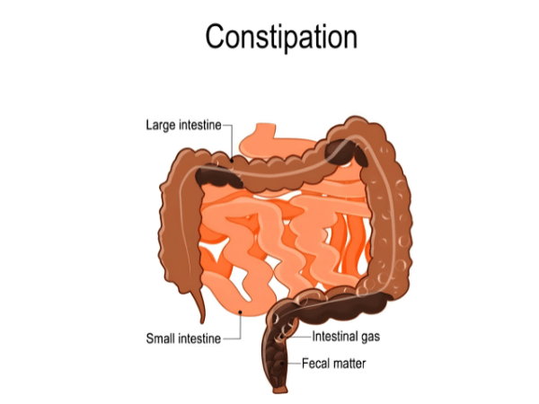 constipation treatment